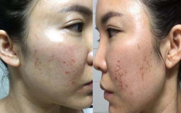 <a href=http://m.f3bb6.cn/listinfo-768-0.html target=_blank class=infotextkey>微針</a>可以去痘坑嗎