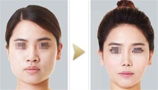 <a href=http://m.f3bb6.cn/listinfo-631-0.html target=_blank class=infotextkey>瘦臉</a><a href=http://m.f3bb6.cn/listinfo-614-0.html target=_blank class=infotextkey>除皺</a>打完能擦臉嗎