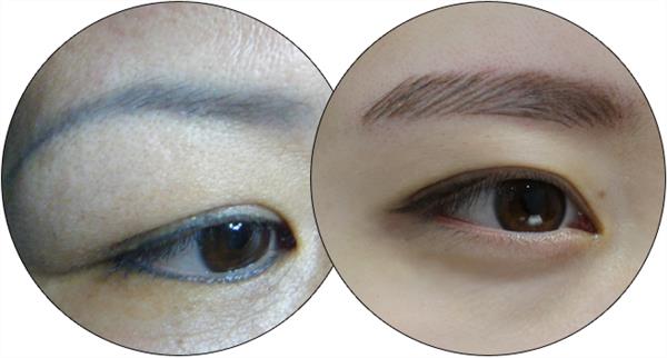 紋眉后一直不結(jié)痂原因