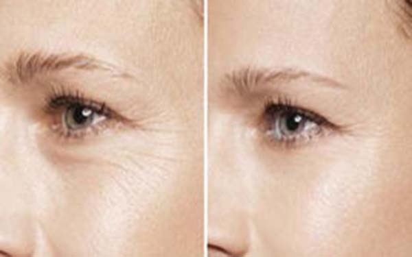 內切祛眼袋多少錢