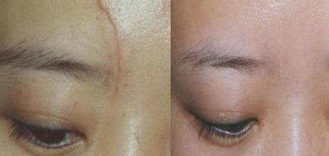 額頭疤痕怎么去除