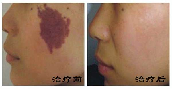 <a href=http://m.f3bb6.cn/listinfo-773-0.html target=_blank class=infotextkey>去胎記</a>多少錢