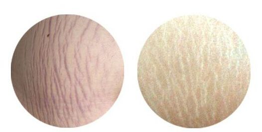 膨脹紋怎么治療