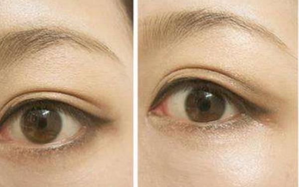 無痕<a href=http://m.f3bb6.cn/listinfo-724-0.html target=_blank class=infotextkey>雙眼皮</a>要多少錢