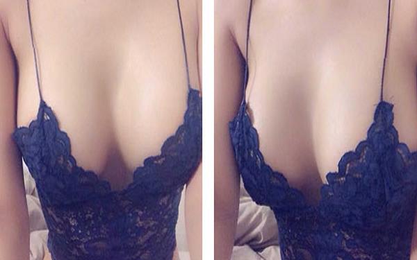 假體豐胸的四大危害