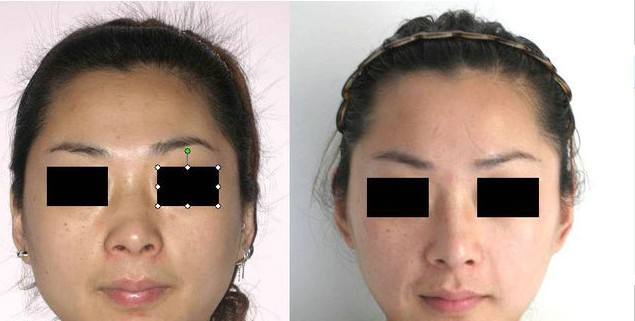 綜合<a href=http://m.f3bb6.cn/listinfo-737-0.html target=_blank class=infotextkey>隆鼻</a>大概多少錢