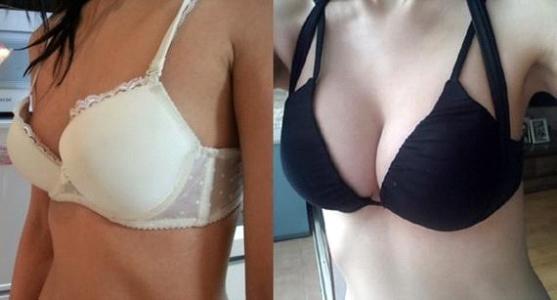 豐胸術后注意事項