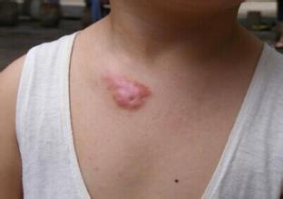 凸增生性疤痕怎么去除