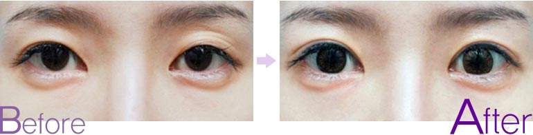 <a href=http://m.f3bb6.cn/listinfo-711-0.html target=_blank class=infotextkey>開眼角</a>手術大概多少錢