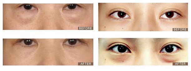 無(wú)痕眼袋去除方法