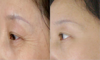 魚尾紋<a href=http://m.f3bb6.cn/listinfo-614-0.html target=_blank class=infotextkey>除皺</a>優(yōu)點有哪些