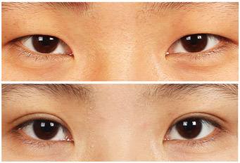 埋線<a href=http://m.f3bb6.cn/listinfo-724-0.html target=_blank class=infotextkey>雙眼皮</a>跟蹤恢復圖