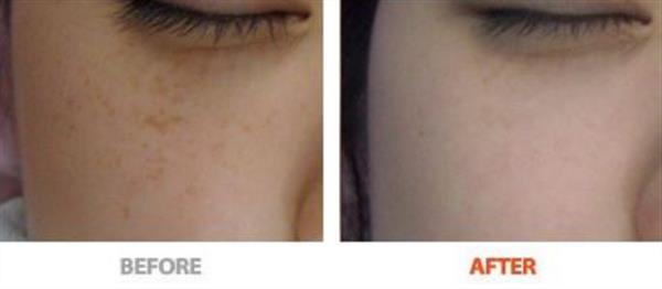 e光<a href=http://m.f3bb6.cn/listinfo-795-0.html target=_blank class=infotextkey>祛斑</a>一般會反彈嗎