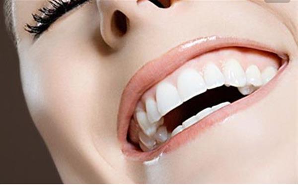 牙瓷貼片維持多久