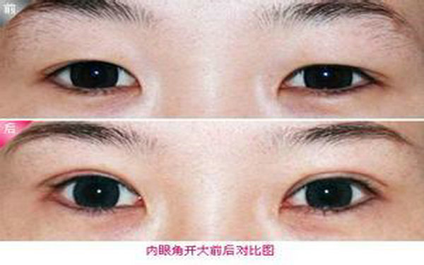 哪里<a href=http://m.f3bb6.cn/listinfo-711-0.html target=_blank class=infotextkey>開眼角</a>較好?