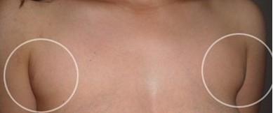 女人長副乳有什么危害