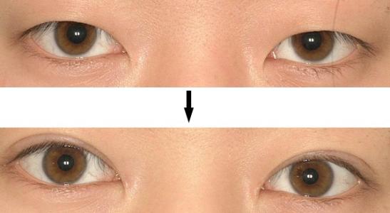 割<a href=http://m.f3bb6.cn/listinfo-724-0.html target=_blank class=infotextkey>雙眼皮</a>是長期性的么?