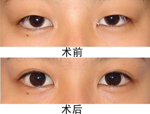 割<a href=http://m.f3bb6.cn/listinfo-724-0.html target=_blank class=infotextkey>雙眼皮</a><a href=http://m.f3bb6.cn/listinfo-711-0.html target=_blank class=infotextkey>開眼角</a>多少錢 割<a href=http://m.f3bb6.cn/listinfo-724-0.html target=_blank class=infotextkey>雙眼皮</a><a href=http://m.f3bb6.cn/listinfo-711-0.html target=_blank class=infotextkey>開眼角</a>費用