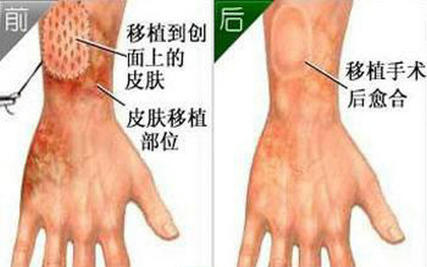皮膚移植手術多少錢?