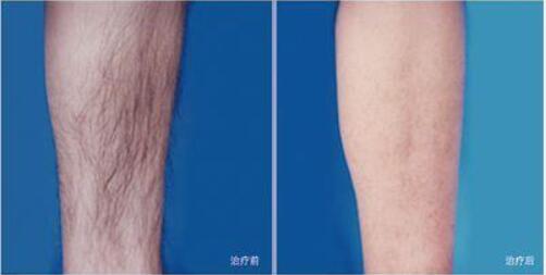 做完冰點<a href=http://m.f3bb6.cn/listinfo-670-0.html target=_blank class=infotextkey>脫毛</a>注意什么