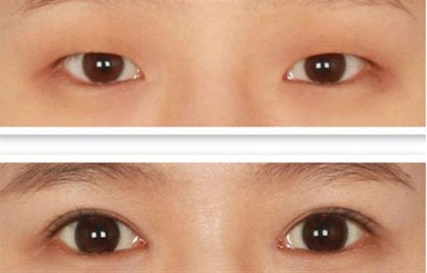 多層褶皺<a href=http://m.f3bb6.cn/listinfo-724-0.html target=_blank class=infotextkey>雙眼皮</a>怎么樣