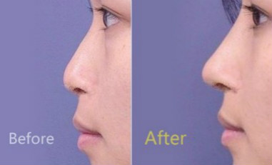 透明質酸<a href=http://m.f3bb6.cn/listinfo-737-0.html target=_blank class=infotextkey>隆鼻</a>變寬能怎么辦