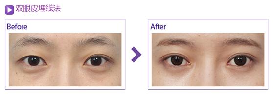 杭州埋線<a href=http://m.f3bb6.cn/listinfo-724-0.html target=_blank class=infotextkey>雙眼皮</a>價格