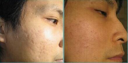 激光痘印多少錢