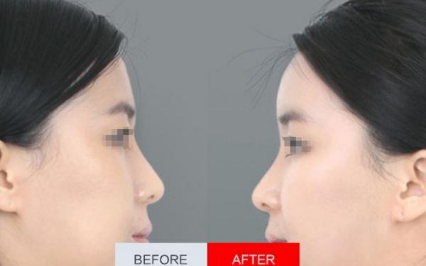 自體脂肪填額頭價(jià)格