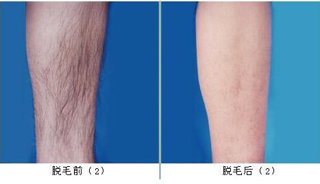 冰點(diǎn)<a href=http://m.f3bb6.cn/listinfo-670-0.html target=_blank class=infotextkey>脫毛</a>后需要怎樣護(hù)理