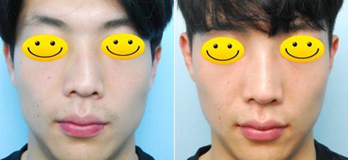 做鼻子價(jià)格