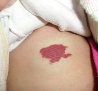 去除胎記安全有效的好方法