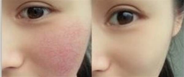 激光<a href=http://m.f3bb6.cn/listinfo-772-0.html target=_blank class=infotextkey>去紅血絲</a>會反彈嗎