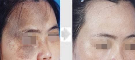 <a href=http://m.f3bb6.cn/listinfo-773-0.html target=_blank class=infotextkey>去胎記</a>的方法有哪些呢