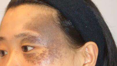 激光<a href=http://m.f3bb6.cn/listinfo-773-0.html target=_blank class=infotextkey>去胎記</a>有什么優(yōu)點(diǎn)呢