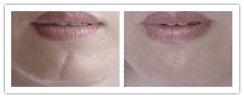 凹陷疤痕有什么好的治療方法