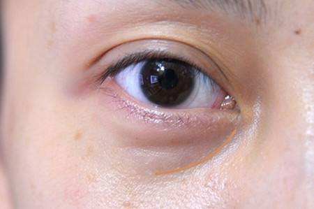 <a href=http://m.f3bb6.cn/listinfo-682-0.html target=_blank class=infotextkey>溶脂</a><a href=http://m.f3bb6.cn/listinfo-708-0.html target=_blank class=infotextkey>去眼袋</a>能維持多久