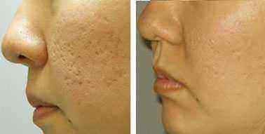 激光去除痘印有哪些好處