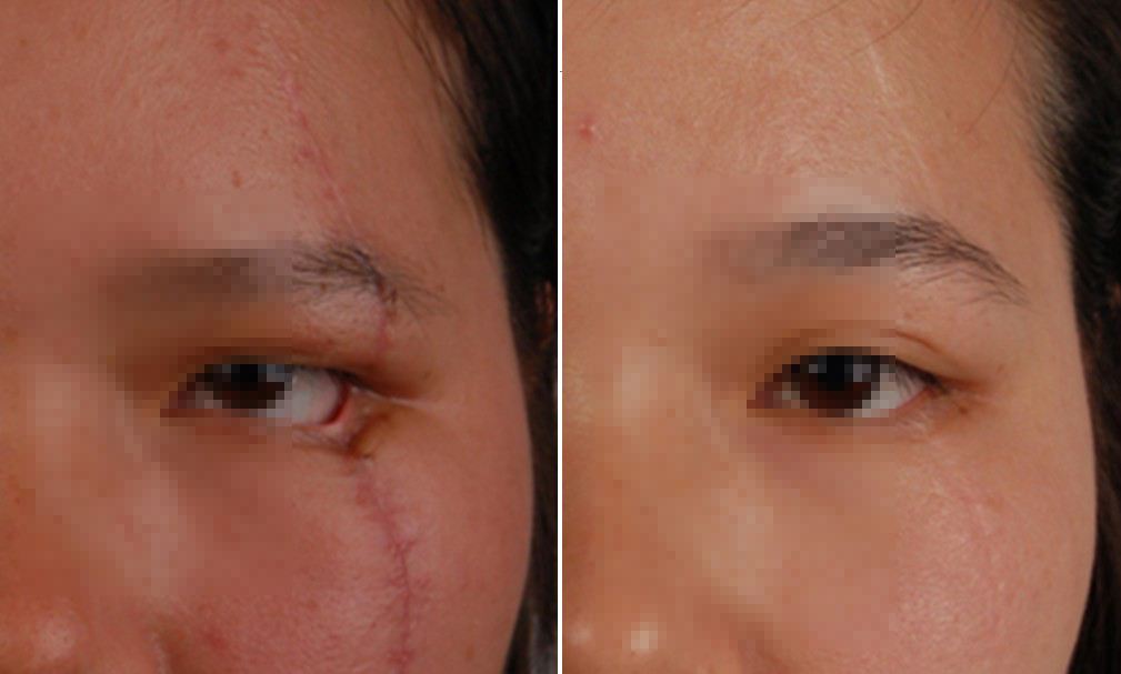 什么樣的疤痕能輕松去除