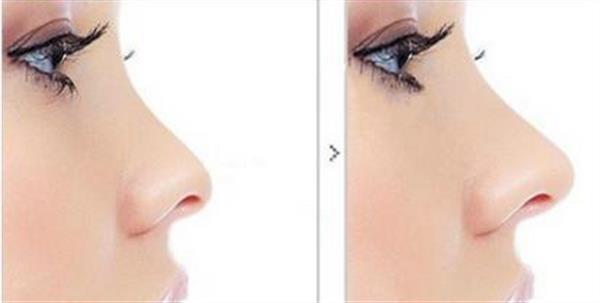 透明質(zhì)酸<a href=http://m.f3bb6.cn/listinfo-737-0.html target=_blank class=infotextkey>隆鼻</a>變寬對(duì)比圖