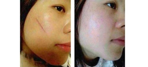 注射<a href=http://m.f3bb6.cn/listinfo-783-0.html target=_blank class=infotextkey>祛疤</a>的效果好不好