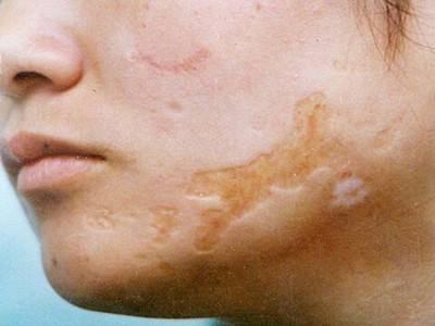 燒傷疤痕怎樣才可以治好