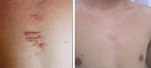 如何讓疤痕皮膚由內而外的好起來