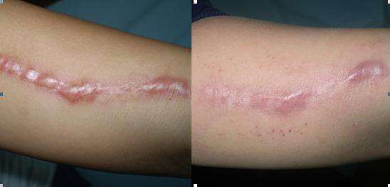 疤痕修復(fù)手術(shù)前后要注意哪些問題