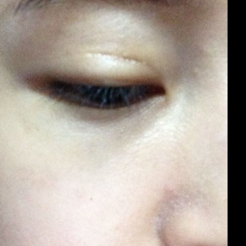 <a href=http://m.f3bb6.cn/listinfo-724-0.html target=_blank class=infotextkey>雙眼皮</a>手術留下的疤痕怎么修復