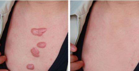 增生性疤痕是怎么回事