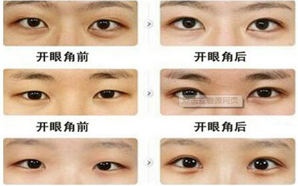 哪種眼睛適合<a href=http://m.f3bb6.cn/listinfo-711-0.html target=_blank class=infotextkey>開眼角</a>?