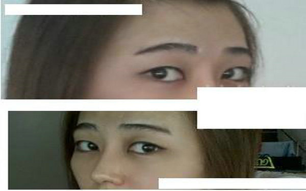 內(nèi)眼角多久才能做修復(fù)?