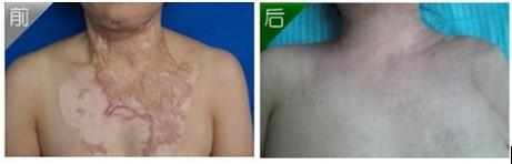 什么樣的疤痕需要手術(shù)祛除