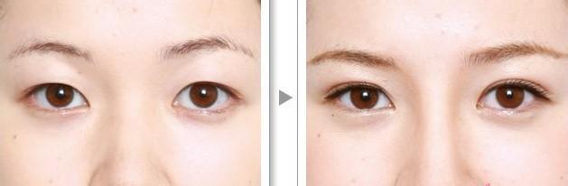 <a href=http://m.f3bb6.cn/listinfo-724-0.html target=_blank class=infotextkey>雙眼皮</a>加<a href=http://m.f3bb6.cn/listinfo-711-0.html target=_blank class=infotextkey>開眼角</a>費用大致是多少